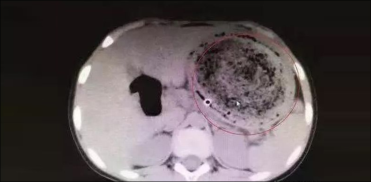 Doctors, hairball, Chinese girl, stomach