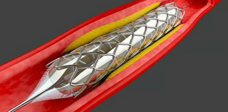 stents case lhc punjab govt response