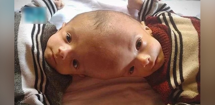 Yemeni-conjoined-twins-to-shortly-fly-to-Riyadh-for-medical-examination